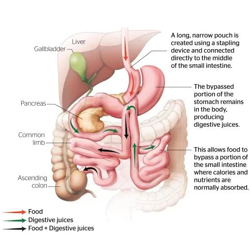 One Anastomosis Gastric Bypass/ Mini Bypass One Anastomosis Gastric Bypass/ Mini Bypass