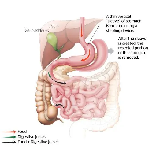 Sleeve Gastrectomy Sleeve Gastrectomy